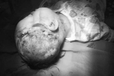 Bé trai 2 tuổi bị chó nhà hàng xóm cắn rách đầu