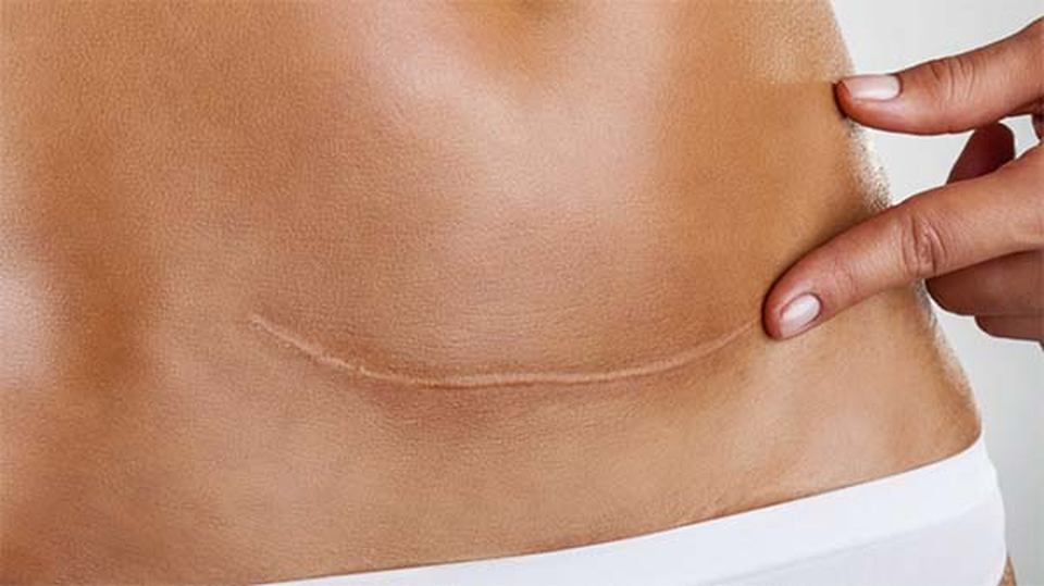 Làm mờ sẹo lâu năm với bí quyết độc quyền - 2 Làm mờ sẹo lâu năm với bí quyết độc quyền - 2