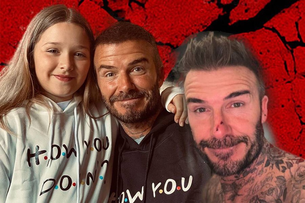David Beckham gặp phản ứng khi đăng ảnh bị con gái cắn chảy máu mũi - 2 David Beckham gặp phản ứng khi đăng ảnh bị con gái cắn chảy máu mũi - 2