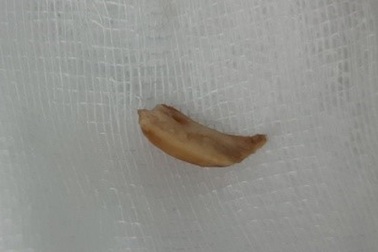 Suy hô hấp vì hóc hạt sen trong cháo