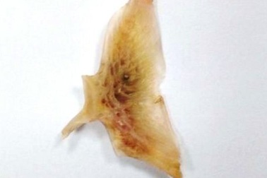 Đau rát vùng thực quản vì mắc nghẹn xương cá to