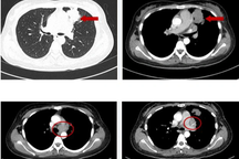Cô gái 25 tuổi bàng hoàng phát hiện ung thư sau một cơn co giật