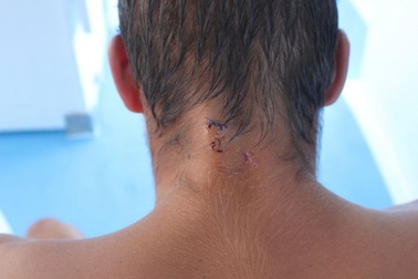 Sống sót thần kỳ sau khi bị cá sấu… ngoạm đầu