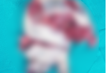 Thay bình ga nồi lẩu, bệnh nhân bị nát tung bàn tay trái