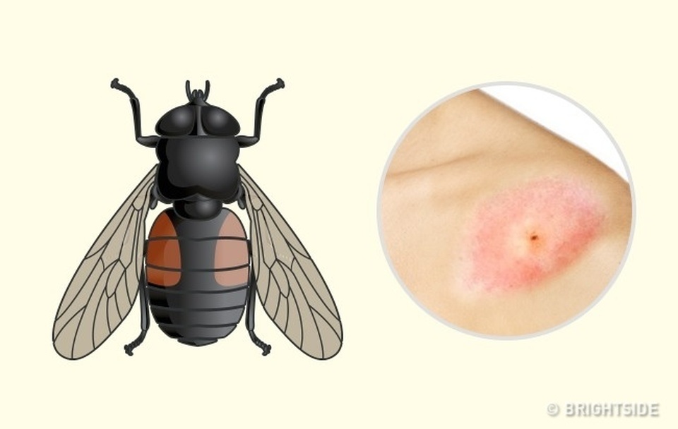 Cách phân biệt 10 vết côn trùng cắn - 8 Cách phân biệt 10 vết côn trùng cắn - 8