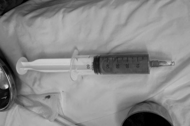 Cô gái trở về từ Malaysia vì ngực rỉ dịch xanh bất thường sau tiêm