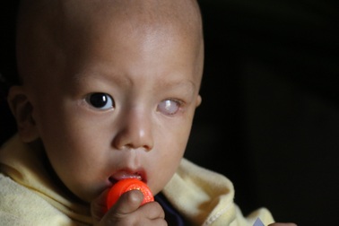 Bé trai chưa tròn một tuổi có nguy cơ mù cả hai mắt vì ung thư