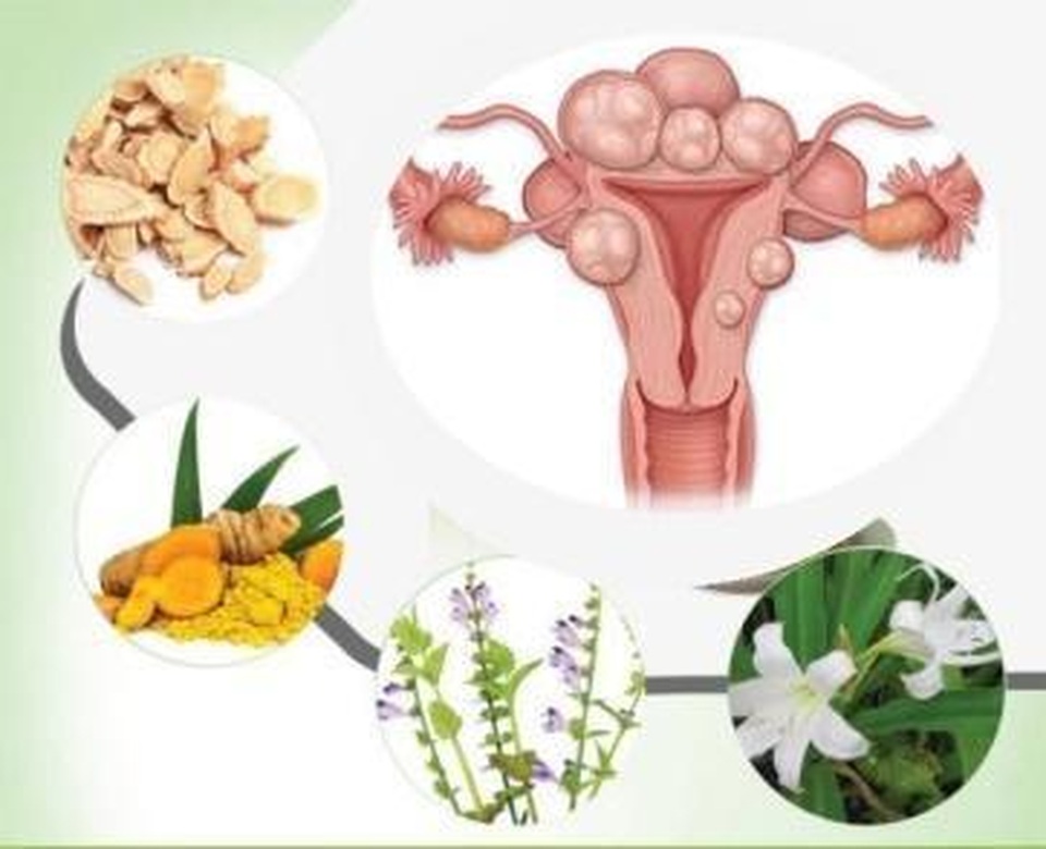 Kinh nguyệt kéo dài – Dấu hiệu u xơ tử cung và giải pháp cải thiện an toàn từ Nga Phụ Khang - 3 Kinh nguyệt kéo dài – Dấu hiệu u xơ tử cung và giải pháp cải thiện an toàn từ Nga Phụ Khang - 3