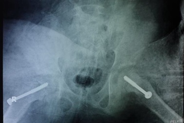 Bé trai trượt chỏm xương đùi cả 2 bên khi chơi đá bóng