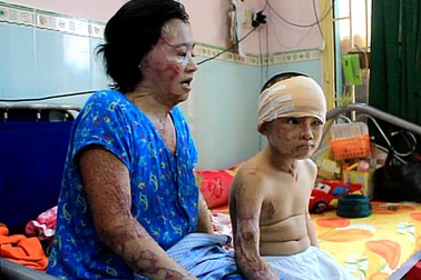 Gặp lại gia đình “sống không bằng chết” do bị tạt axit