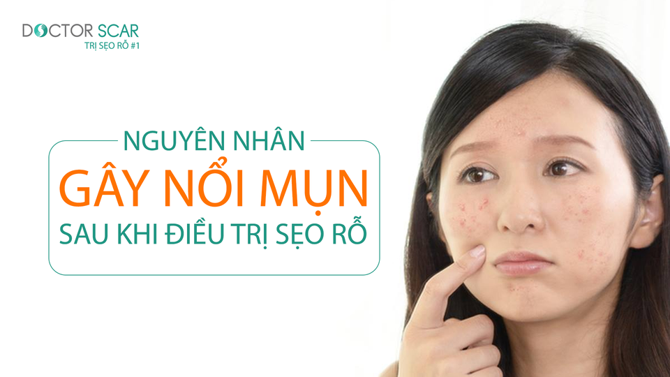 Bác sĩ da liễu giải đáp thắc mắc về việc nổi mụn sau khi điều trị sẹo rỗ - 2 Bác sĩ da liễu giải đáp thắc mắc về việc nổi mụn sau khi điều trị sẹo rỗ - 2