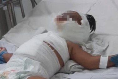 TPHCM: Bé gái 1 tuổi bỏng thương tâm vì ngã vào nồi nước sôi mẹ nấu