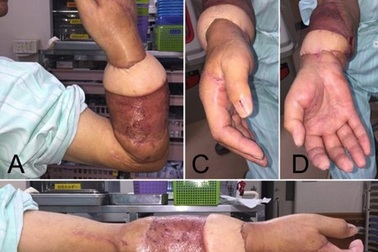 Mục sở thị một ca phẫu thuật nối liền cánh tay bị đứt lìa