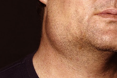 Nỗi ám ảnh… teo tinh hoàn sau quai bị