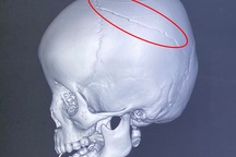 Bé 4 tuổi nứt hộp sọ, nguy kịch vì tai nạn thường gặp