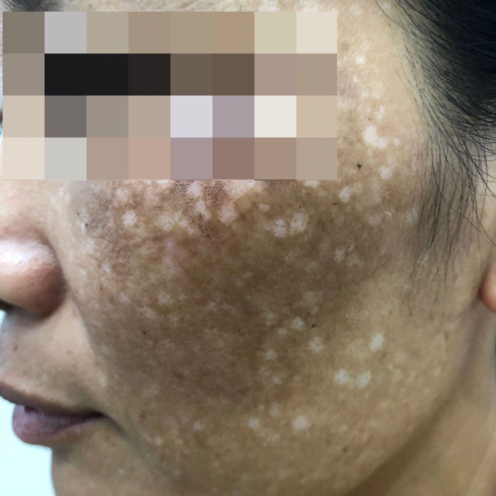 Rủ nhau dùng lá trầu trị nám, 4 phụ nữ mặt loang lổ sau một đêm - 2 Rủ nhau dùng lá trầu trị nám, 4 phụ nữ mặt loang lổ sau một đêm - 2