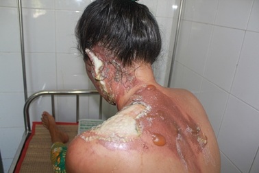 Chồng tạt nước sôi khiến vợ bỏng nặng