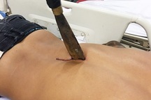 Nam thanh niên nhập viện với con dao bầu đâm xuyên lưng