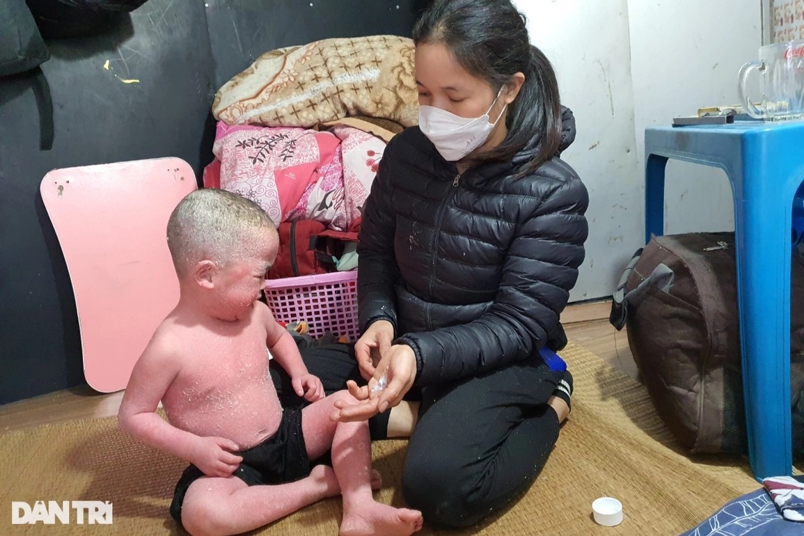 Thương bé trai 5 tuổi mắc căn bệnh kỳ lạ, đau đớn khóc thét mỗi lần mặc áo - 3 Thương bé trai 5 tuổi mắc căn bệnh kỳ lạ, đau đớn khóc thét mỗi lần mặc áo - 3