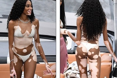 Siêu mẫu bạch biến tự tin diện bikini