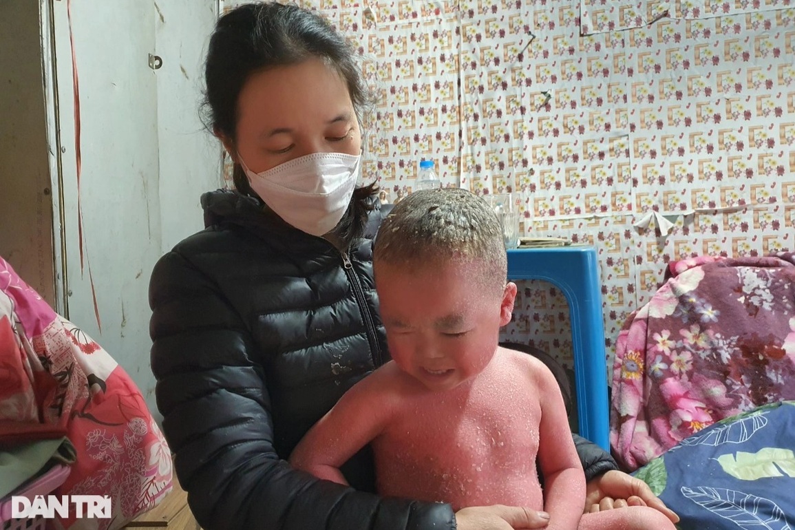 Thương bé trai 5 tuổi mắc căn bệnh kỳ lạ, đau đớn khóc thét mỗi lần mặc áo - 5 Thương bé trai 5 tuổi mắc căn bệnh kỳ lạ, đau đớn khóc thét mỗi lần mặc áo - 5