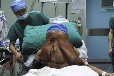 “Người voi” mang khối u hàng chục kg trên mặt