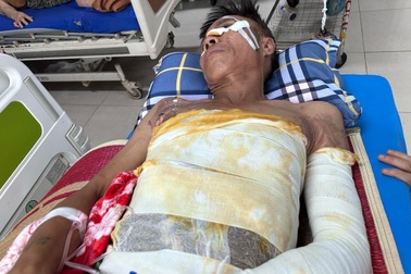 Con gái khẩn cầu cứu cha nghèo đơn thân bị điện giật bỏng nặng khi làm thuê