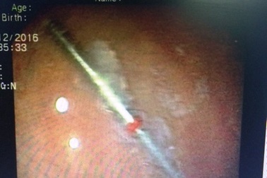 Đi làm răng, nuốt phải... mũi khoan nha sĩ