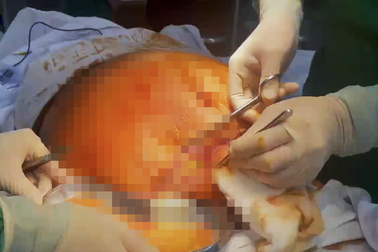 Người phụ nữ thủng ruột nguy kịch sau hút mỡ, 81 ngày chống chọi tử thần