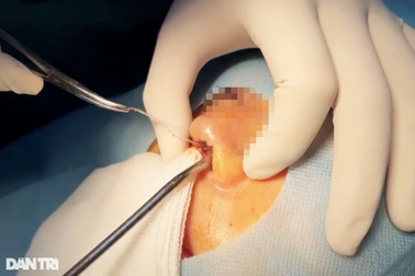 Cô gái 28 tuổi nguy kịch trong lúc phẫu thuật thẩm mỹ nâng mũi ở TPHCM