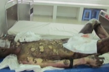 Bị bỏng nặng khi tẩm xăng đốt vợ con