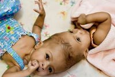 Tách rời thành công cặp song sinh dính liền đầu