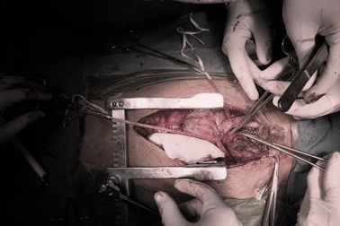 Vướng khi nuốt do có u sợi thần kinh hiếm gặp