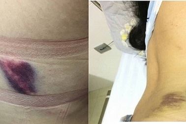 Lùm xùm vụ chuyên viên Sở GD-ĐT bị tố hành hung gây thương tích cho bạn gái