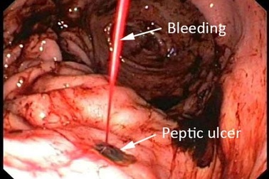 Nôn ra máu vì nhậu nhiều