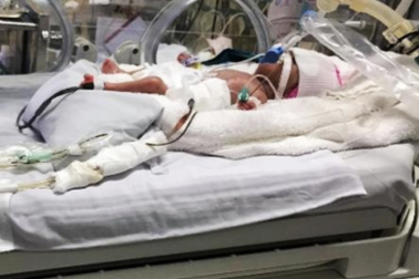 Cảnh báo nhiều trẻ sinh non thủng ruột sau khi chào đời