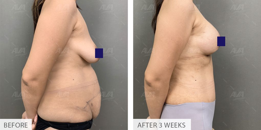 Bệnh viện AVA tiên phong với công nghệ Embrace RF giúp tạo hình thẩm mỹ không để lại sẹo - 3 Bệnh viện AVA tiên phong với công nghệ Embrace RF giúp tạo hình thẩm mỹ không để lại sẹo - 3