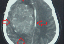 Người phụ nữ bị động kinh liên tục do bị khối u màng não khổng lồ