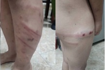 Khẩn trương điều tra vụ bé 11 tuổi nghi bị mẹ đẻ bạo hành