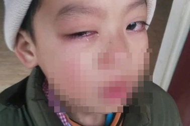 Lạng Sơn: Phụ huynh tố giáo viên dùng thước kẻ đánh học sinh lớp 1 đến hỏng mắt