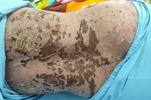 Người phụ nữ suýt mất mạng vì điều trị đau khớp bằng thuốc nam