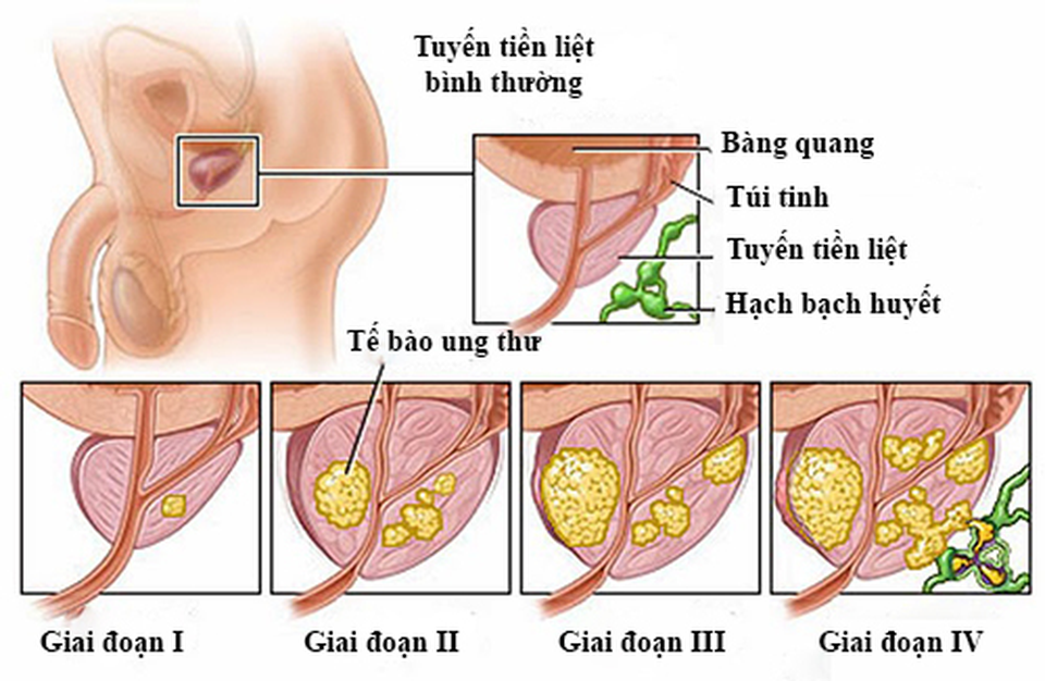 Yếu tố nguy cơ của ung thư tuyến tiền liệt - 2 Yếu tố nguy cơ của ung thư tuyến tiền liệt - 2