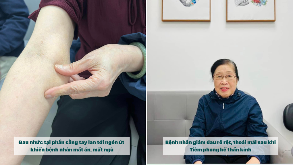 Đã khỏi zona nhưng cơn đau không dứt: Giải pháp mới từ điện quang can thiệp - 3 Đã khỏi zona nhưng cơn đau không dứt: Giải pháp mới từ điện quang can thiệp - 3