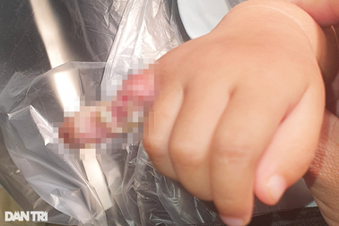 TPHCM: Bé gái 2 tuổi bỏng thương tâm vì đưa tay vào bóng đèn đang cắm điện