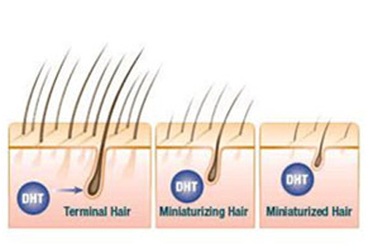 DHT: Thủ phạm của 80% trường hợp rụng tóc, hói đầu