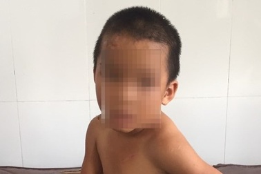 Vụ bé trai bị cắt thịt, dí thuốc lá cháy: Khởi tố, tạm giam gã cha dượng