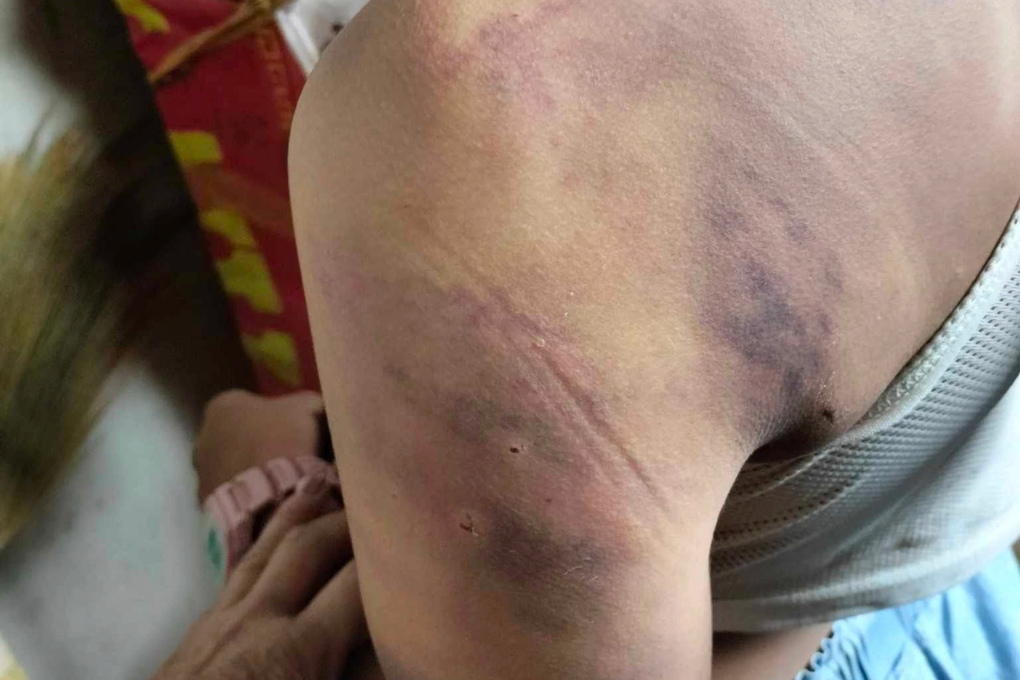 Nữ sinh lớp 4 nhập viện, khủng hoảng vì bị 10 bạn cùng lớp đánh hội đồng - 2 Nữ sinh lớp 4 nhập viện, khủng hoảng vì bị 10 bạn cùng lớp đánh hội đồng - 2