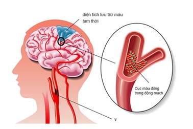 Thiếu máu não - Không nên chủ quan