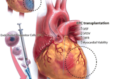 Bệnh nhân tim Việt Nam được điều trị bằng tế bào gốc