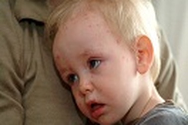 Bệnh thủy đậu cần được quan tâm đúng mức